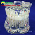 DENTAL09(12568) Human Adult Size Transparent Disease Oral Model